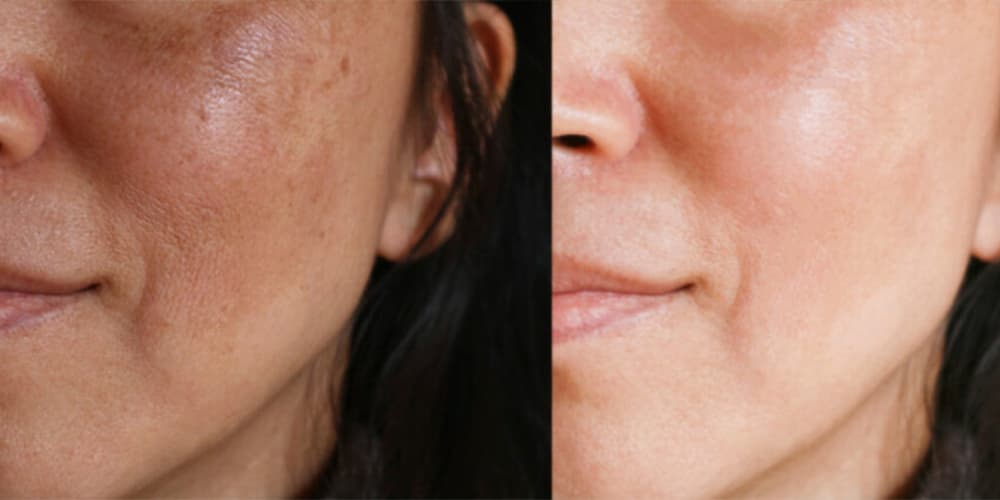 Treatment before and after