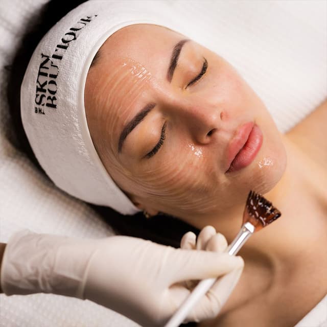 Advanced Chemical Peel Treatment