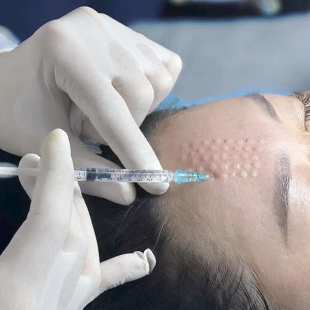 Advanced Mesotherapy Treatment