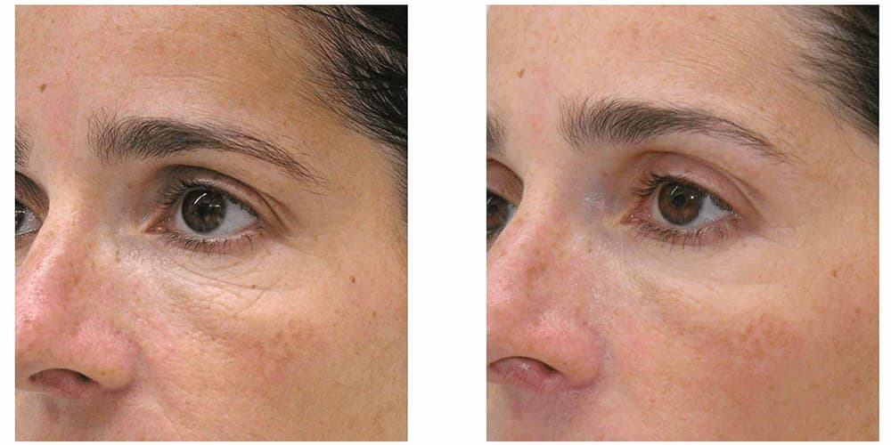 Treatment before and after