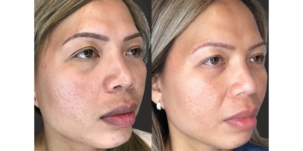 Treatment before and after