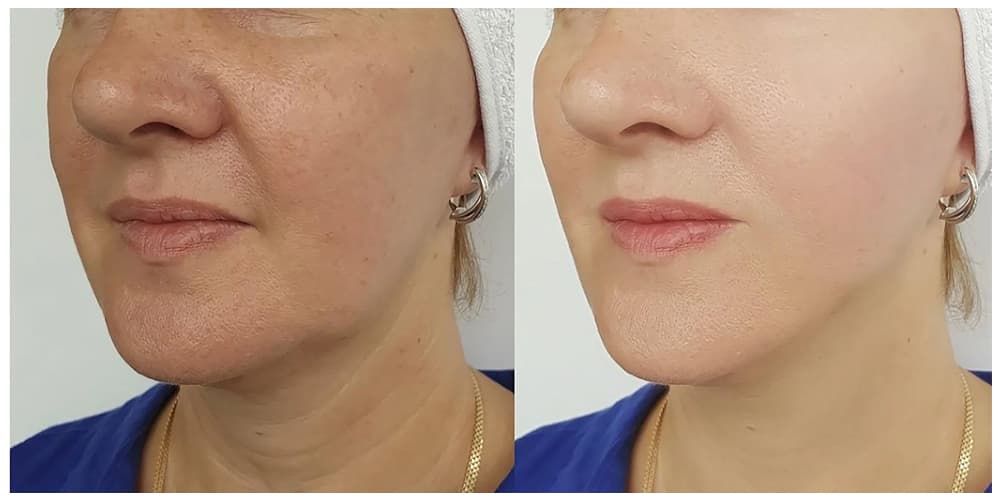 Treatment before and after