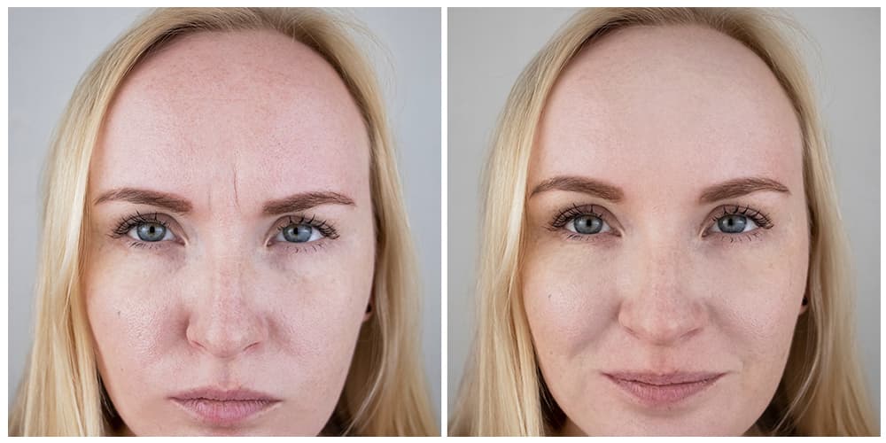 Treatment before and after