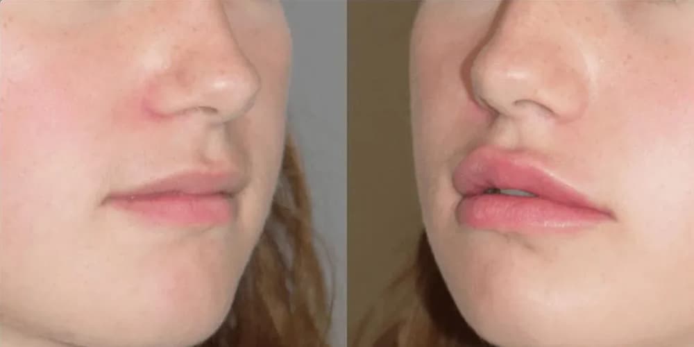 Treatment before and after