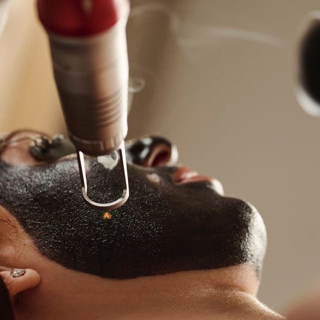 Carbon Laser Facial