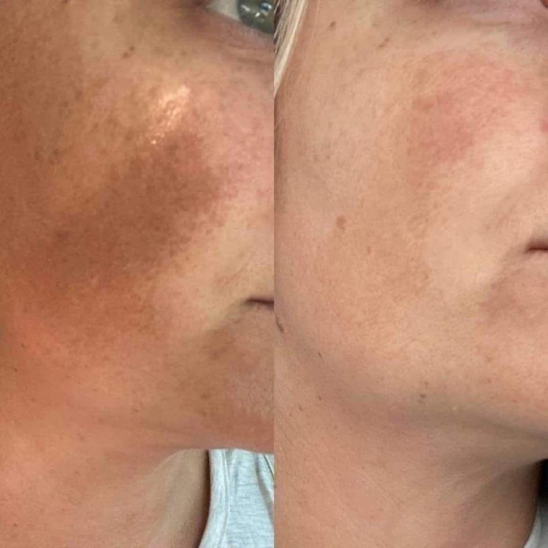 Treatment before and after