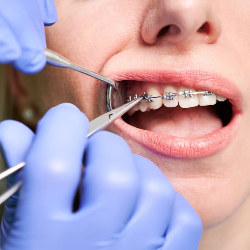 Braces & Aligners